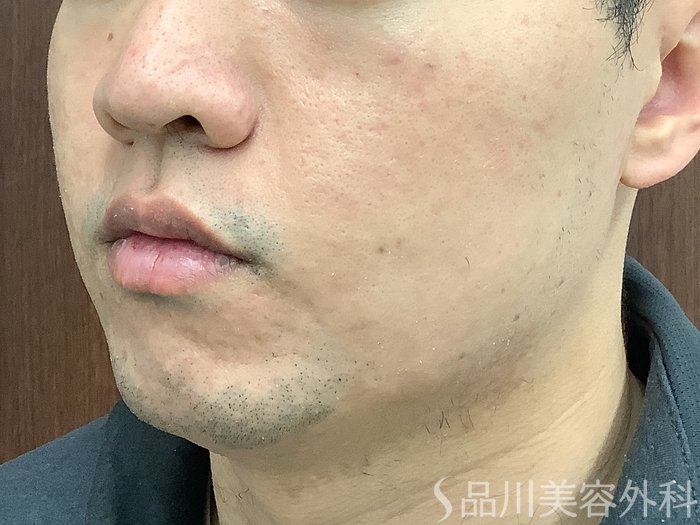 症例NO.62317のAFTER写真