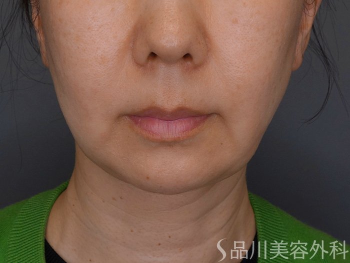 症例NO.74657のBEFORE写真