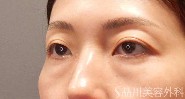 症例NO.74880のBEFORE写真