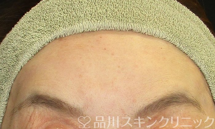 症例NO.74206のAFTER写真
