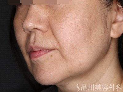 症例NO.72821のAFTER写真