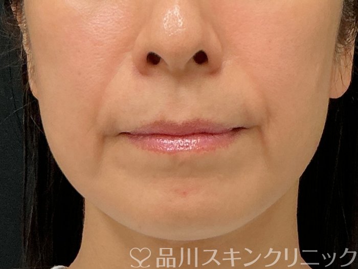 症例NO.74888のBEFORE写真