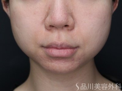 症例NO.69388のBEFORE写真