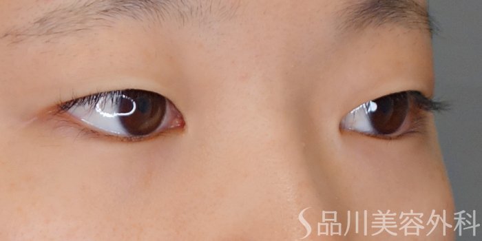 症例NO.70131のBEFORE写真