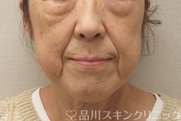 症例NO.75072のBEFORE写真