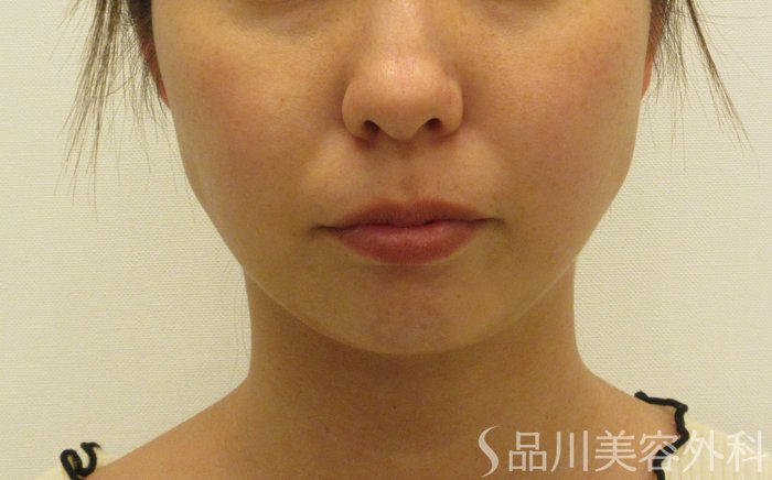 症例NO.72472のBEFORE写真