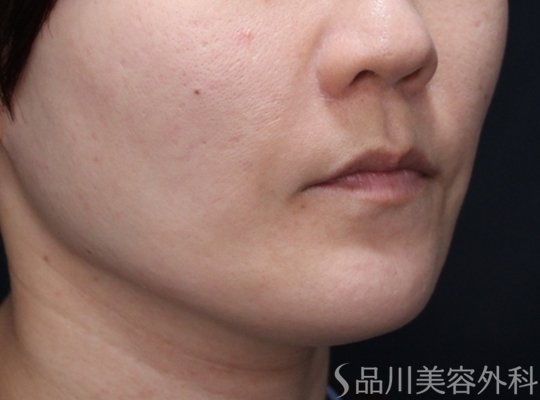 症例NO.74046のBEFORE写真