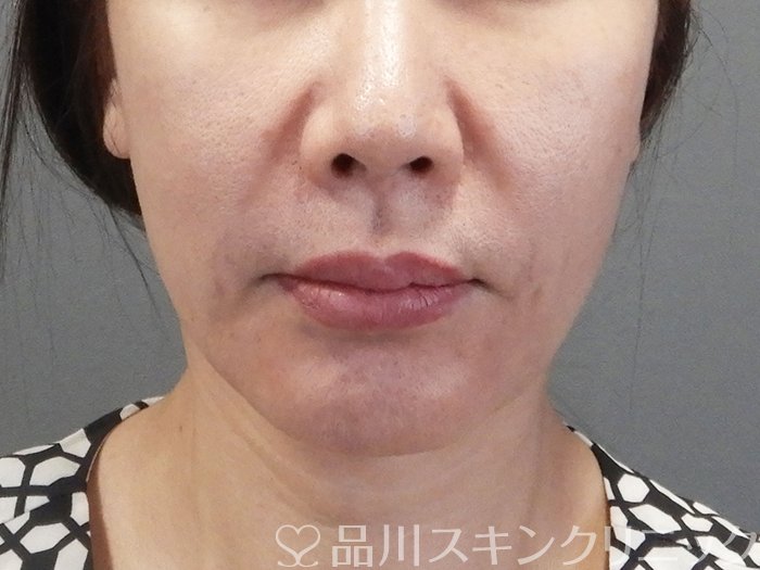 症例NO.75178のBEFORE写真