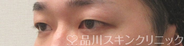 症例NO.74410のBEFORE写真