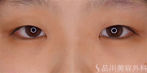 症例NO.56000のBEFORE写真