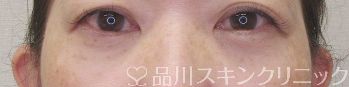 症例NO.71297のAFTER写真