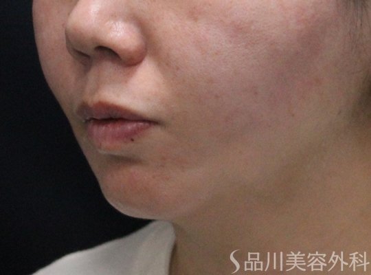 症例NO.75104のAFTER写真