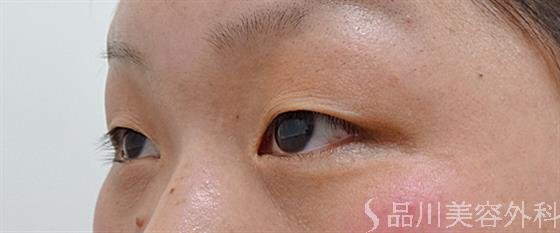 症例NO.54819のBEFORE写真