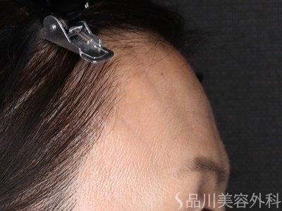 症例NO.71485のBEFORE写真