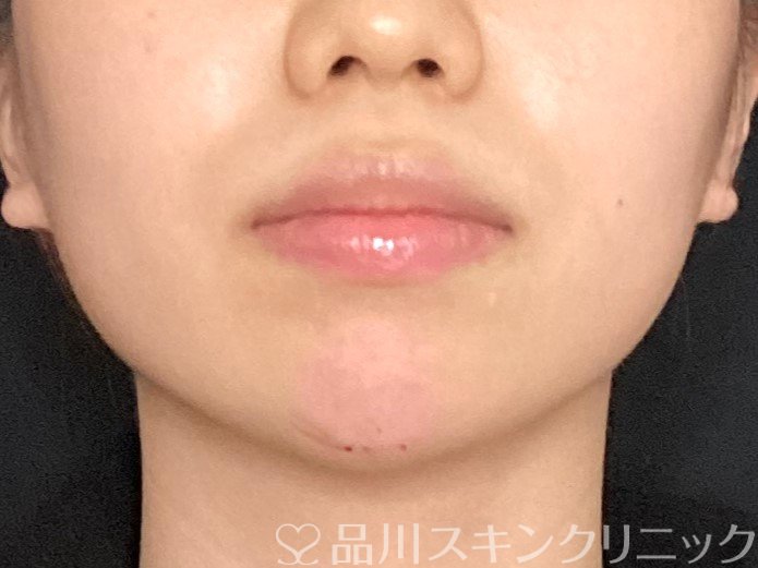 症例NO.65481のAFTER写真