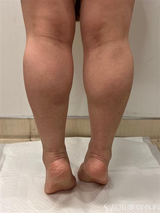 症例NO.55096のBEFORE写真