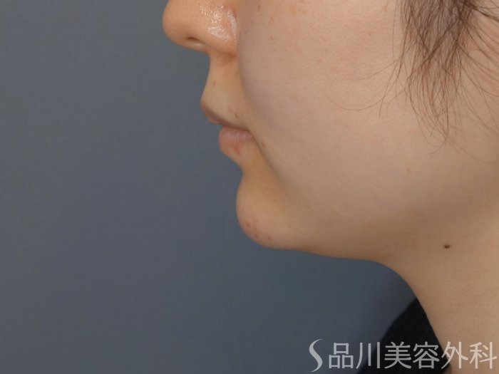 症例NO.72146のAFTER写真