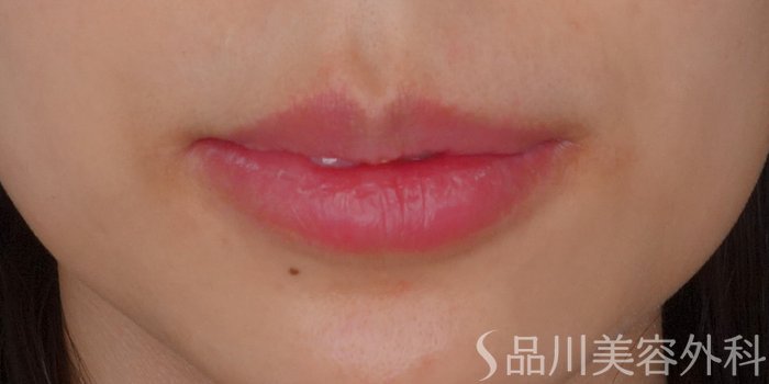 症例NO.72259のAFTER写真