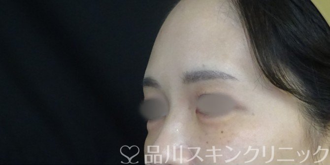 症例NO.71154のAFTER写真