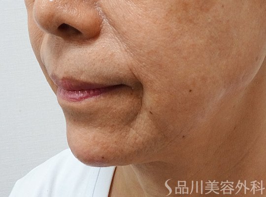 症例NO.73520のAFTER写真