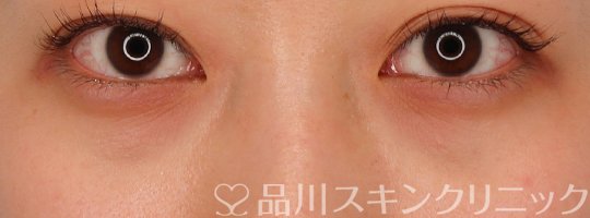 症例NO.69307のBEFORE写真