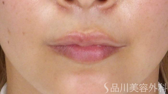 症例NO.70128のBEFORE写真