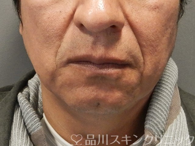 症例NO.75134のBEFORE写真