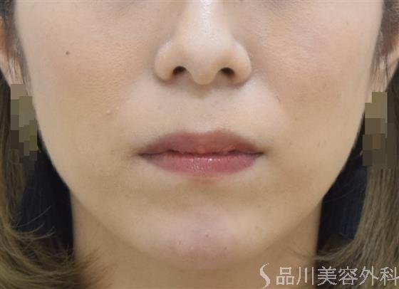 症例NO.42878のAFTER写真