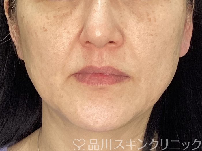 症例NO.72901のBEFORE写真