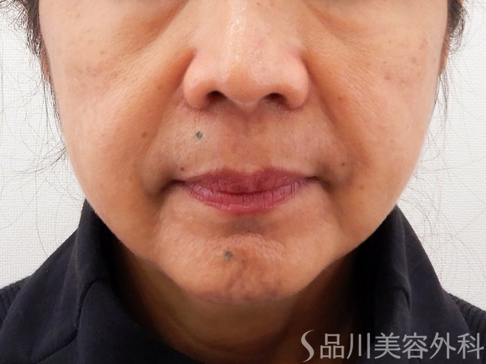 症例NO.62186のBEFORE写真