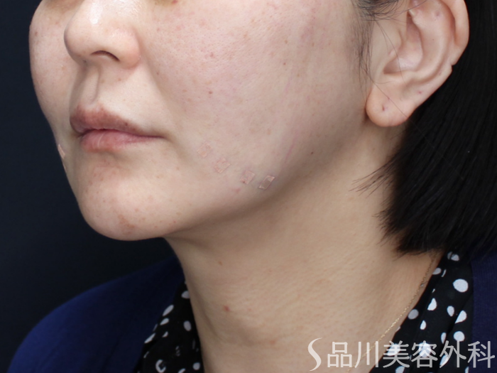 症例NO.71633のAFTER写真