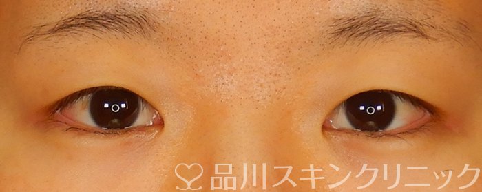 症例NO.63913のBEFORE写真