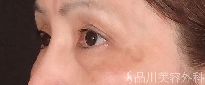 症例NO.70126のBEFORE写真