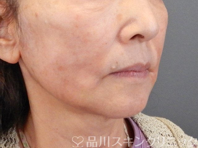 症例NO.75299のAFTER写真