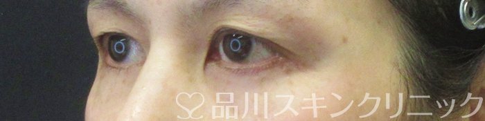症例NO.64326のBEFORE写真