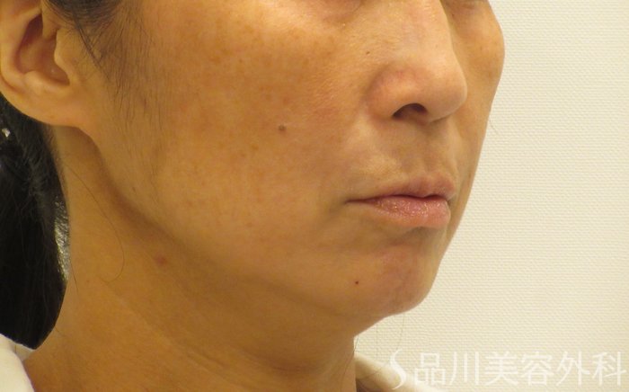 症例NO.74013のBEFORE写真