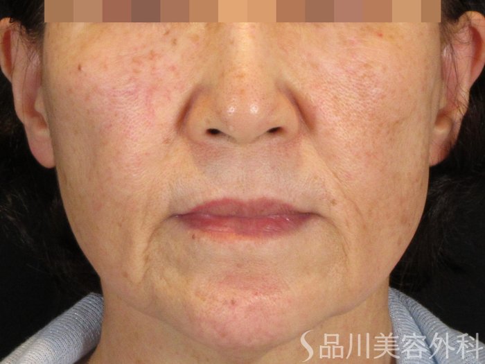 症例NO.75371のBEFORE写真