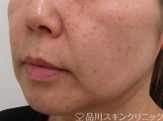 症例NO.41629のBEFORE写真