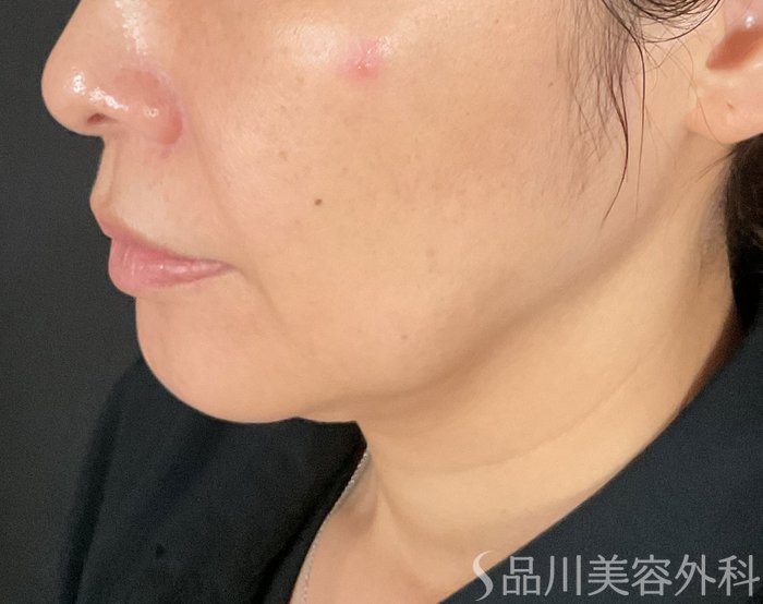 症例NO.75286のBEFORE写真