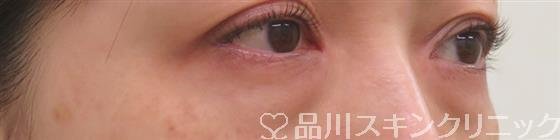 症例NO.55212のBEFORE写真