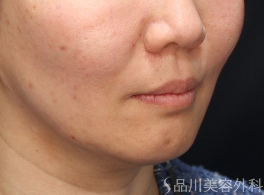 症例NO.73333のAFTER写真