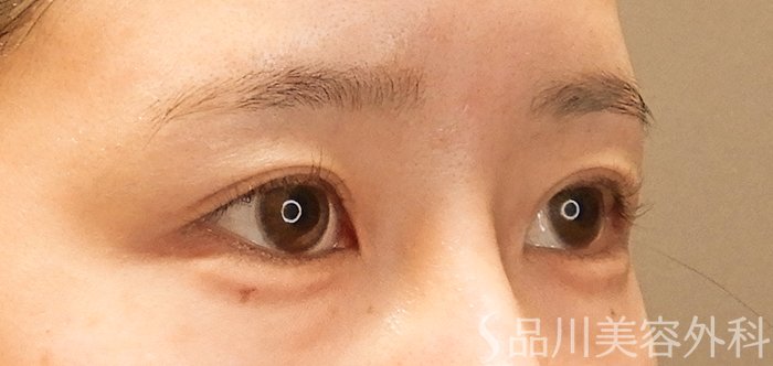 症例NO.68027のAFTER写真