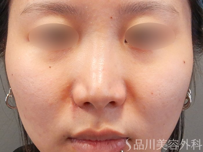 症例NO.71910のAFTER写真