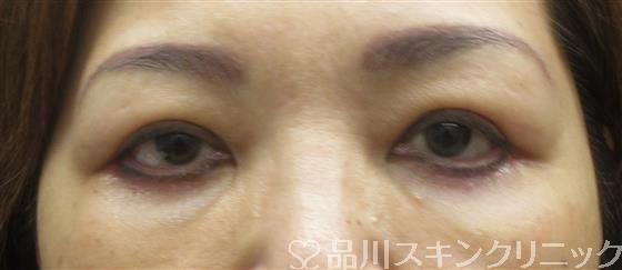 症例NO.61439のAFTER写真