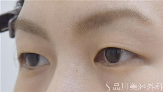 症例NO.52538のBEFORE写真