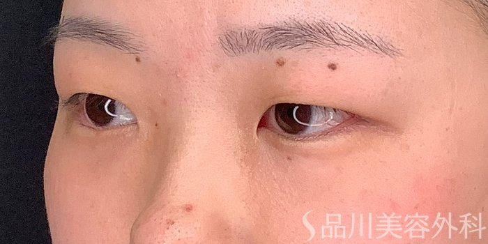 症例NO.71234のBEFORE写真