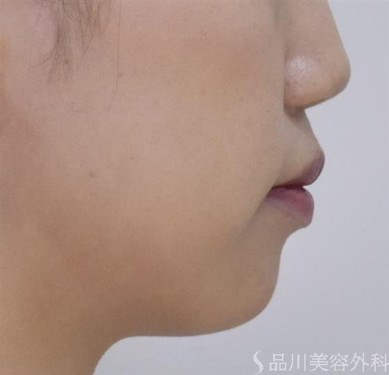 症例NO.49292のBEFORE写真