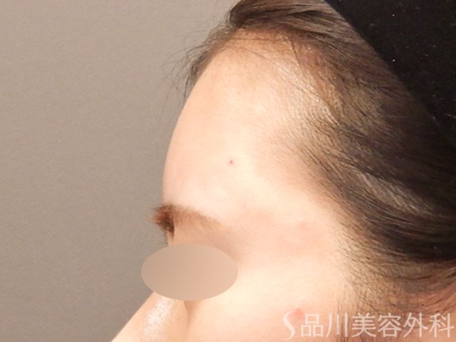 症例NO.72529のAFTER写真