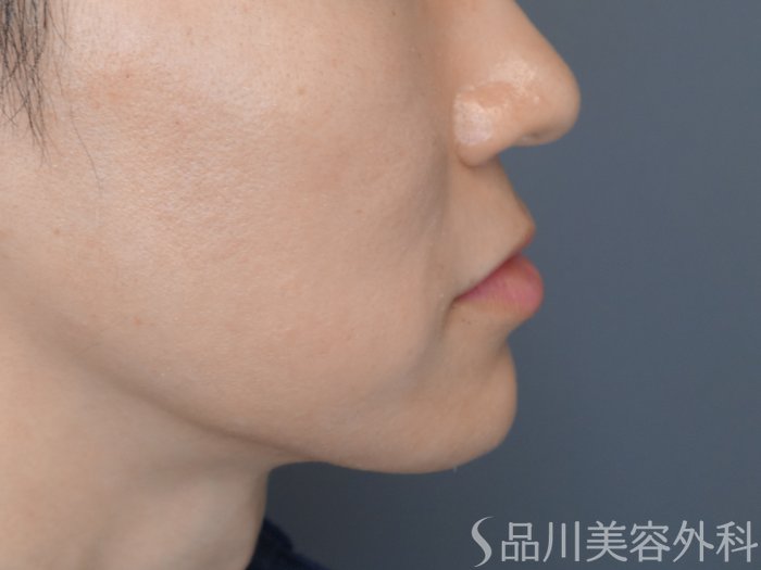 症例NO.73081のAFTER写真