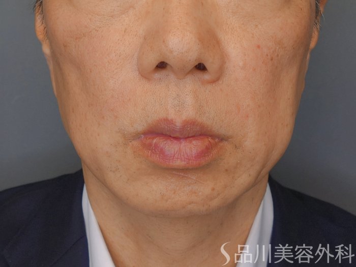 症例NO.73357のAFTER写真